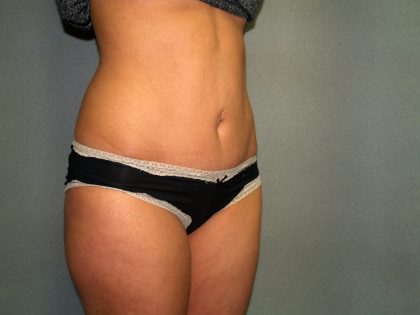 Tummy Tuck Before & After Patient #1875