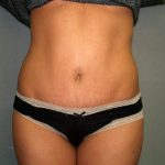 Tummy Tuck Before & After Patient #1875