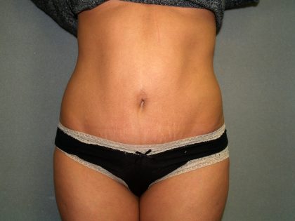 Tummy Tuck Before & After Patient #1875