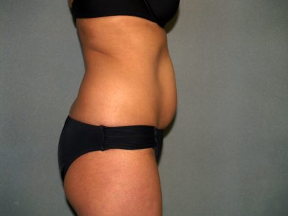 Tummy Tuck Before & After Patient #1875