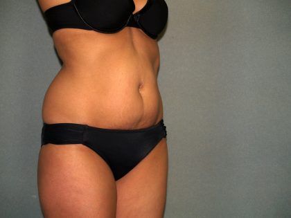 Tummy Tuck Before & After Patient #1875