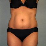 Tummy Tuck Before & After Patient #1875