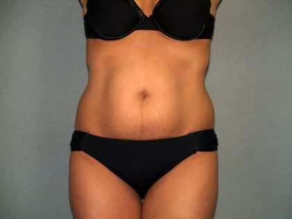 Tummy Tuck Before & After Patient #1875