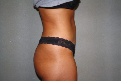 Tummy Tuck Before & After Patient #1883