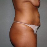 Tummy Tuck Before & After Patient #1883