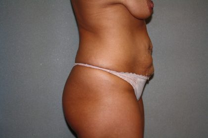 Tummy Tuck Before & After Patient #1883