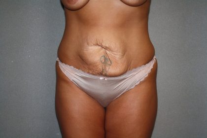 Tummy Tuck Before & After Patient #1883