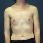 Breast Augmentation Before & After Patient #2566