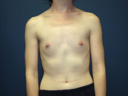 Breast Augmentation Before & After Patient #2566