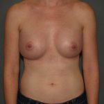 Breast Augmentation Before & After Patient #2566