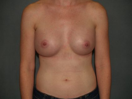 Breast Augmentation Before & After Patient #2566