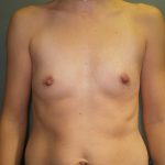 Breast Augmentation Before & After Patient #2913