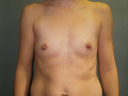 Breast Augmentation Before & After Patient #2913