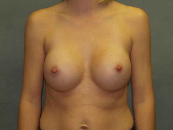 Breast Augmentation Before & After Patient #2913
