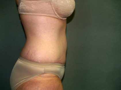 Tummy Tuck Before & After Patient #1892