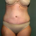 Tummy Tuck Before & After Patient #1892