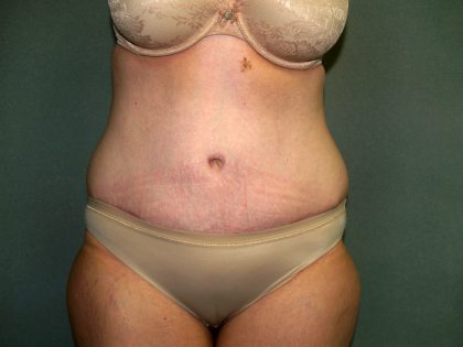 Tummy Tuck Before & After Patient #1892