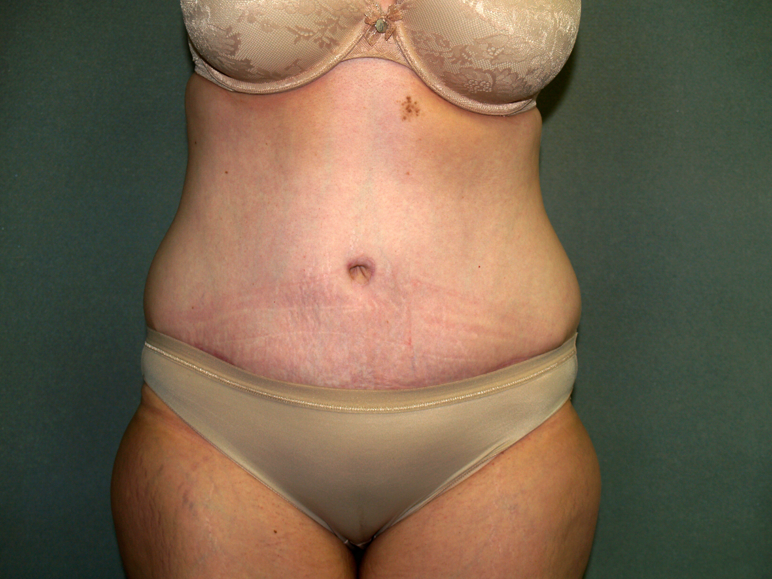 Tummy Tuck Before & After Patient #1892