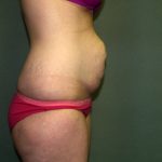 Tummy Tuck Before & After Patient #1892