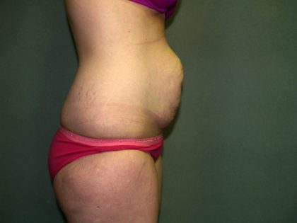 Tummy Tuck Before & After Patient #1892