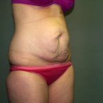 Tummy Tuck Before & After Patient #1892