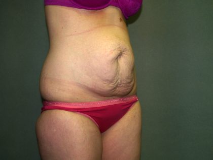 Tummy Tuck Before & After Patient #1892