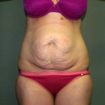 Tummy Tuck Before & After Patient #1892