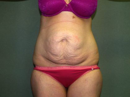 Tummy Tuck Before & After Patient #1892