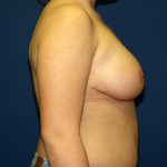 Breast Reduction Before & After Patient #3194