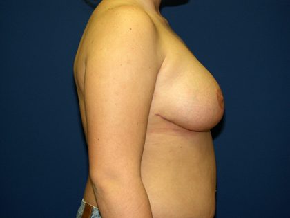 Breast Reduction Before & After Patient #3194