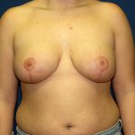 Breast Reduction Before & After Patient #3194