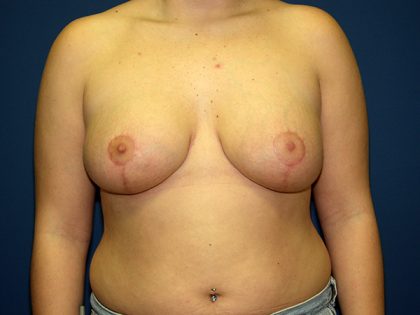 Breast Reduction Before & After Patient #3194