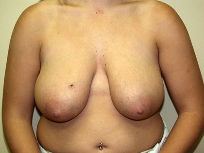 Breast Reduction Before & After Patient #3194