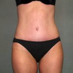 Tummy Tuck Before & After Patient #1861