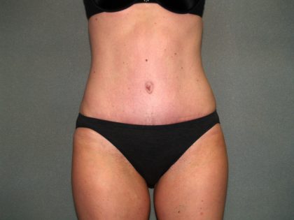 Tummy Tuck Before & After Patient #1861