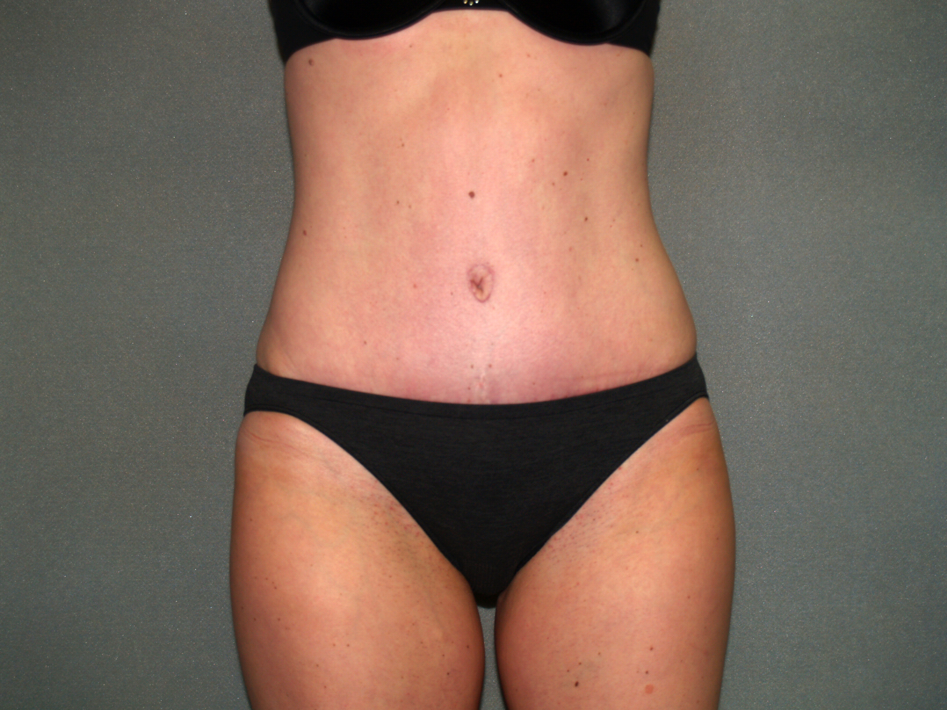 Tummy Tuck Before & After Patient #1861