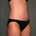 Tummy Tuck Before & After Patient #1861