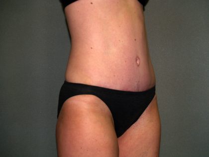 Tummy Tuck Before & After Patient #1861