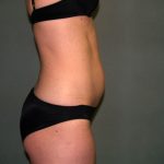 Tummy Tuck Before & After Patient #1861