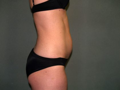 Tummy Tuck Before & After Patient #1861