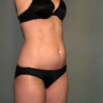 Tummy Tuck Before & After Patient #1861