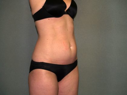 Tummy Tuck Before & After Patient #1861