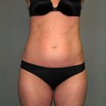 Tummy Tuck Before & After Patient #1861