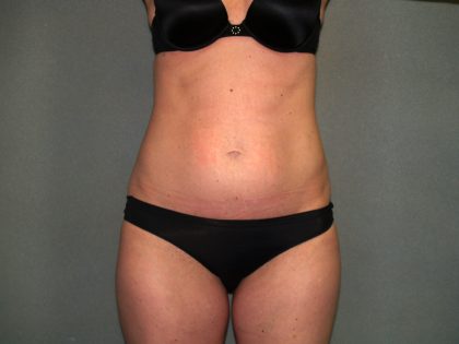 Tummy Tuck Before & After Patient #1861