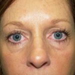 Eye Lid Lift Before & After Patient #682