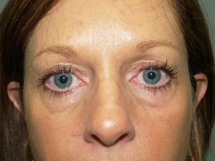 Eye Lid Lift Before & After Patient #682