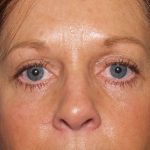 Eye Lid Lift Before & After Patient #682