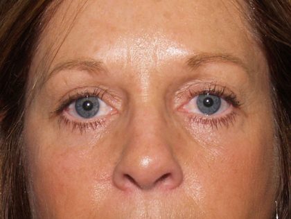 Eye Lid Lift Before & After Patient #682