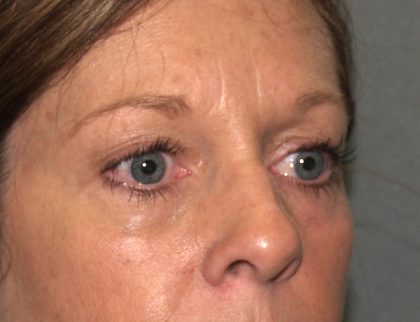 Eye Lid Lift Before & After Patient #682