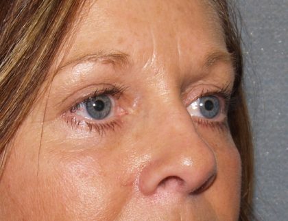 Eye Lid Lift Before & After Patient #682